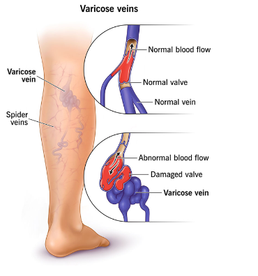 Varicose Veins Treatment